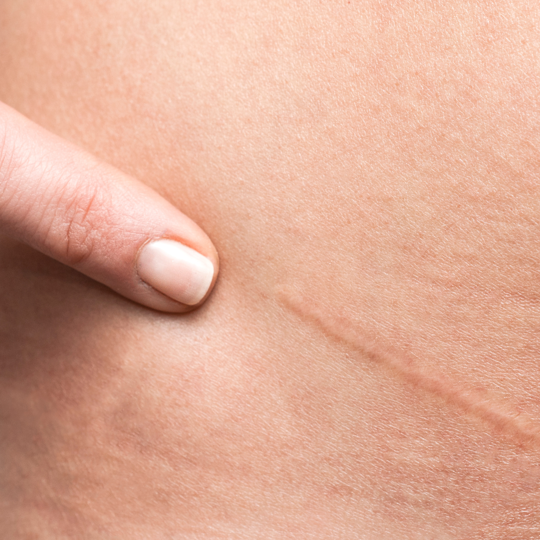 BRIGHT pigment-lightening TouchStick for dark scars