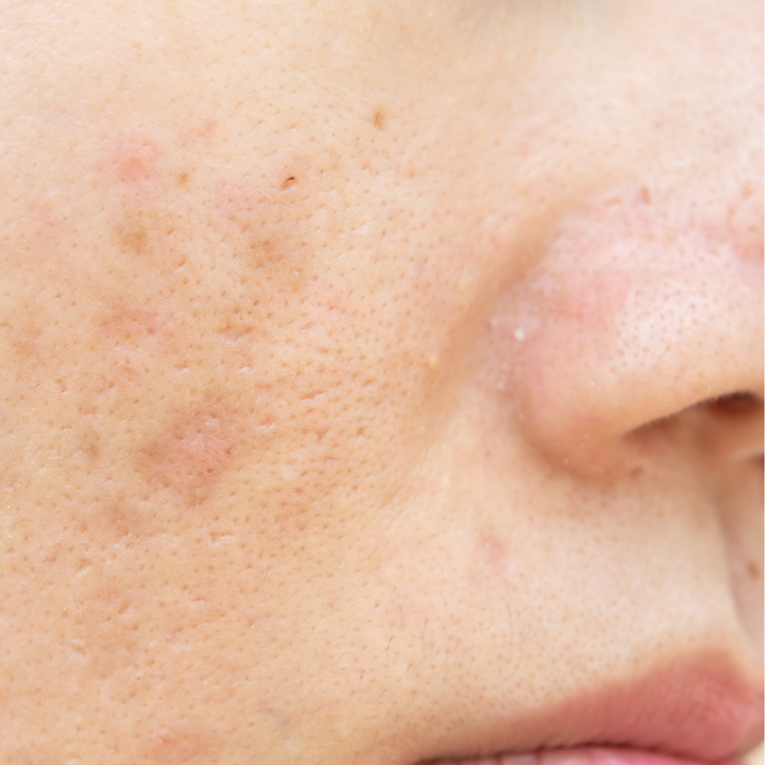 BRIGHT pigment-lightening TouchStick for dark spots, hyperpigmentation and scar discoloration